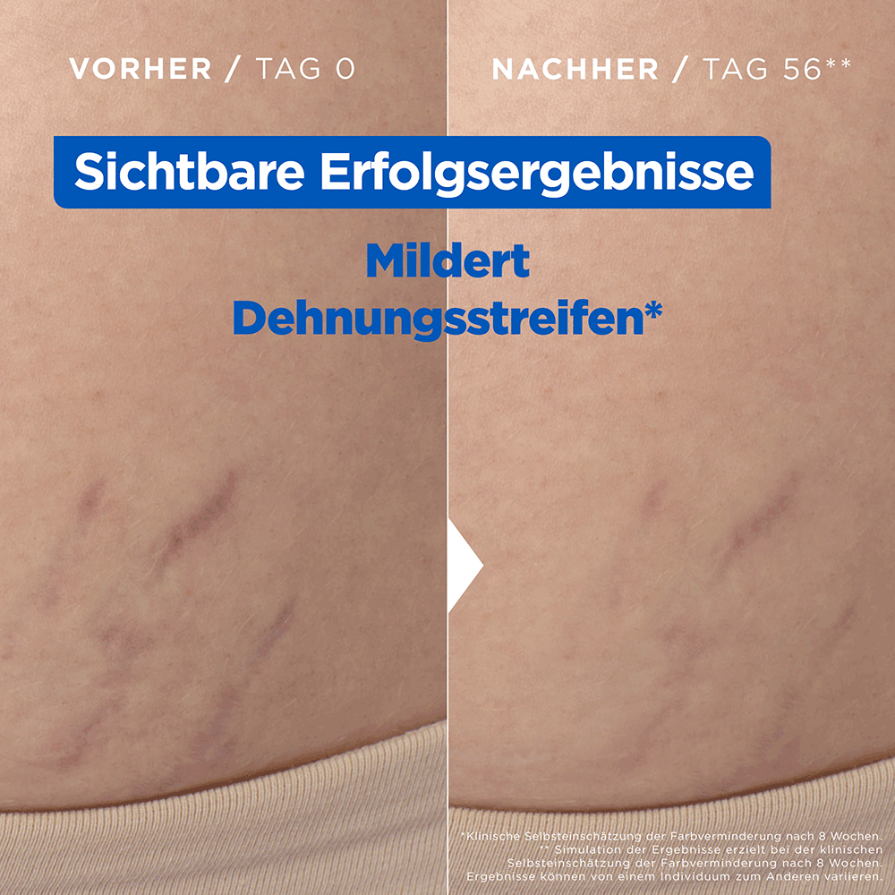 Bild: Mixa Niacinamide Stretchmark Oil