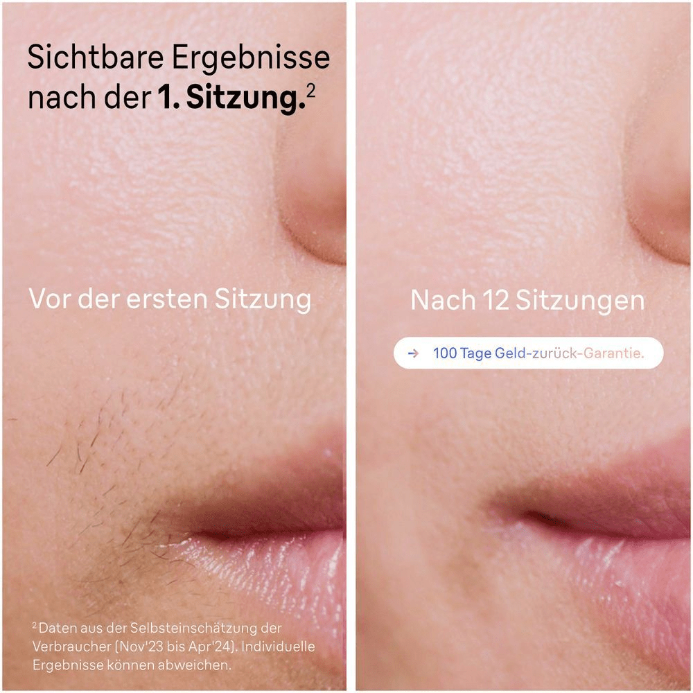 Bild: Braun IPL Skin i·expert PL7147