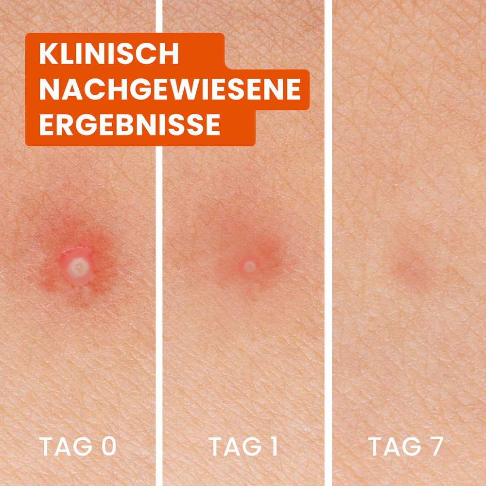 Bild: Bioré Anti-Pickel Patches 3in1