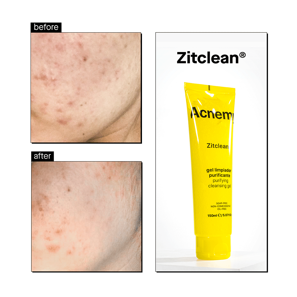 Bild: Acnemy Zitclean Reinigungsgel Purifying