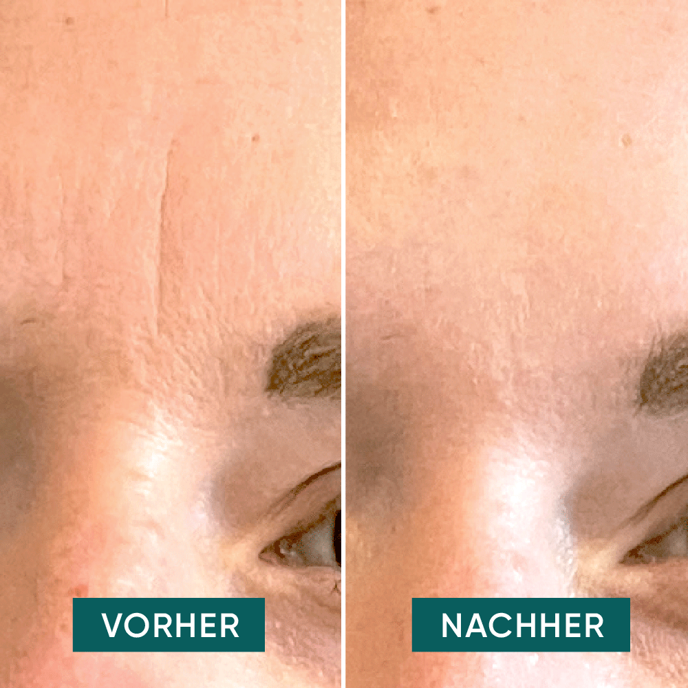 Bild: APRICOT Beauty Gesicht Patches für Stirn- & Zornesfalten