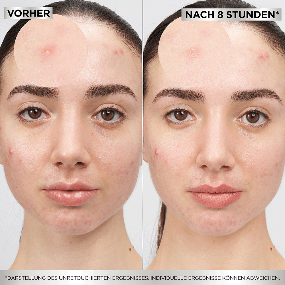 Bild: GARNIER 8H Invisible Pimple Patch
