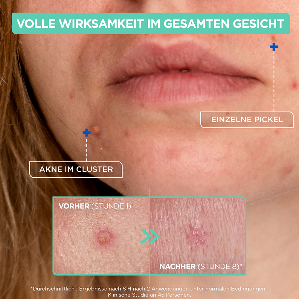Bild: Mixa Konzentrierte Anti-Pickel-Paste 
