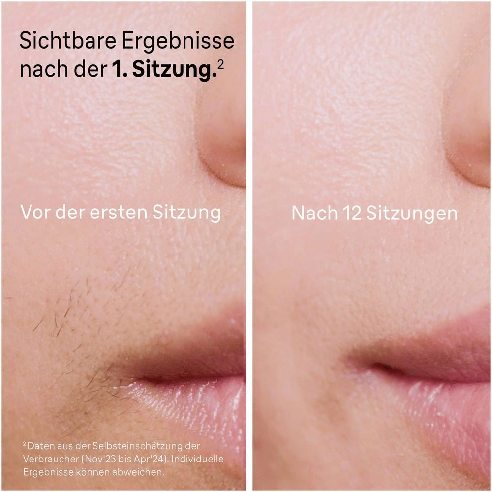 Braun IPL-Gerät in Anwendung, begleitet von einer App, die eine 80% "Ausgezeichnete" Abdeckung anzeigt.
